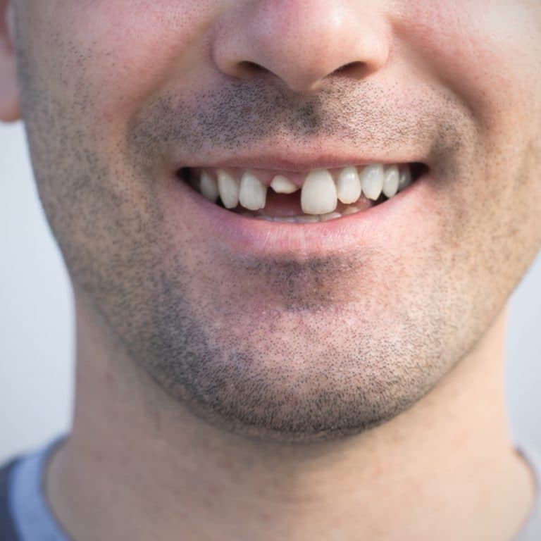Knocked-out or broken tooth: first aid in the first 30 minutes