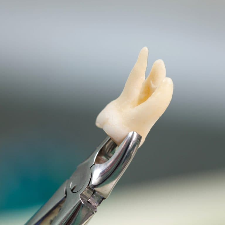 Bleeding after a tooth extraction: what's normal